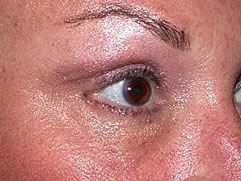 Lower Eyelid Surgery - Before