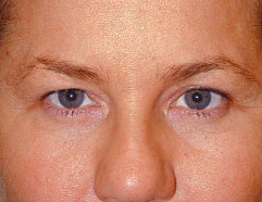 Endoscopic Browlift - After