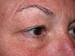 Lower Eyelid Surgery - After
