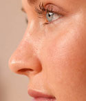 rhinoplasty - woman's face