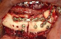 Mandible stabilized with plate and screw fixation